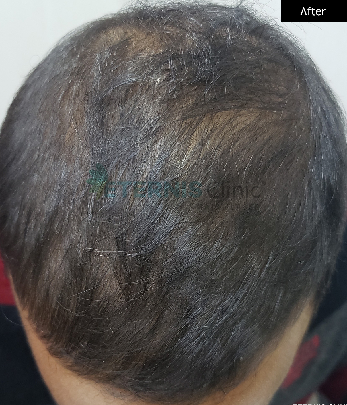 After: Pattern hair regrowth, 9 months