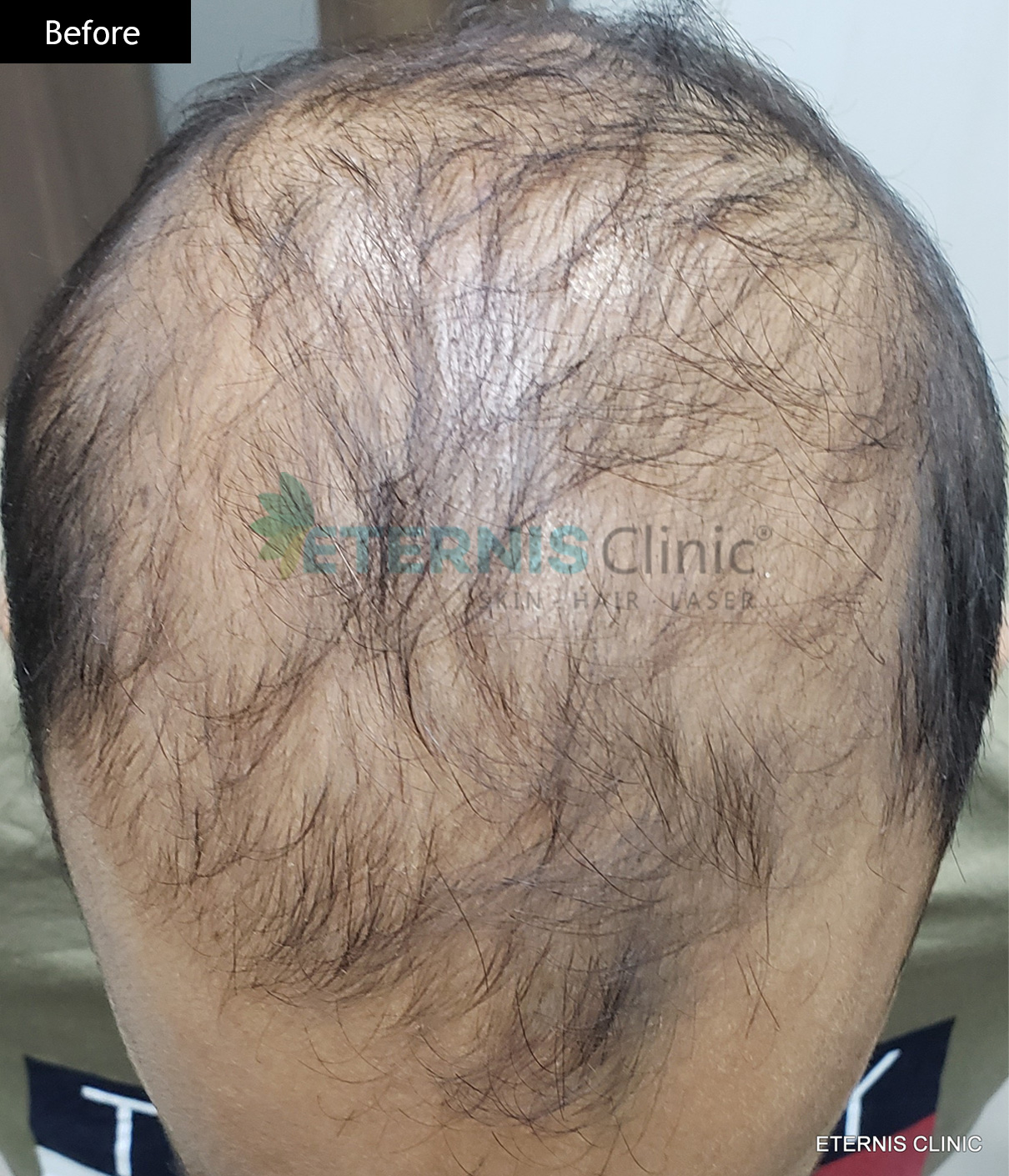 Before: Pattern hair regrowth, 9 months
