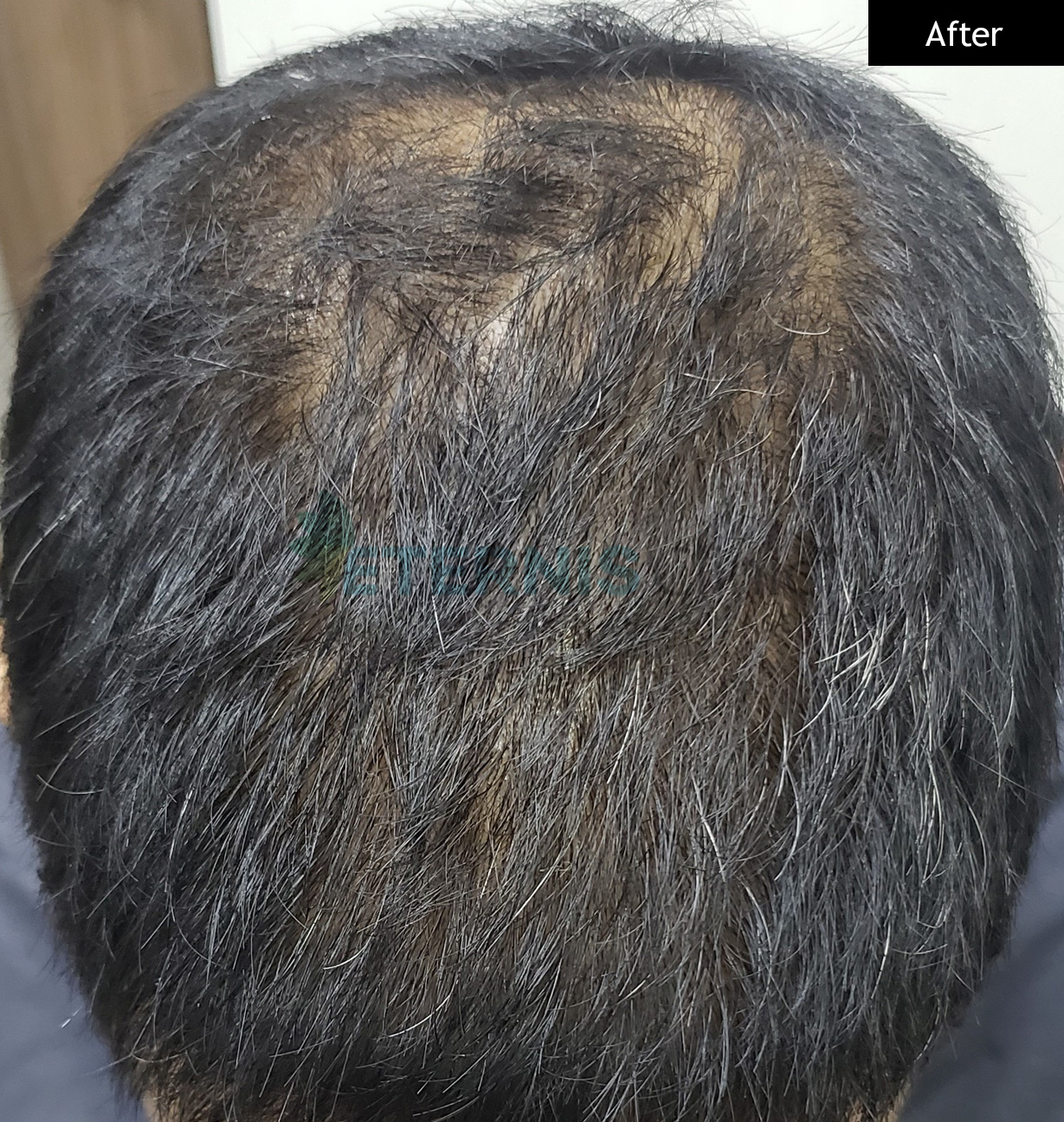 After: Frontal thinning, 6 months