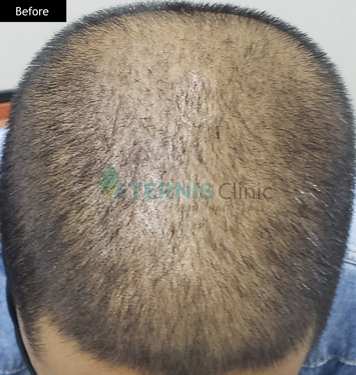 Before: Frontal thinning, 6 months
