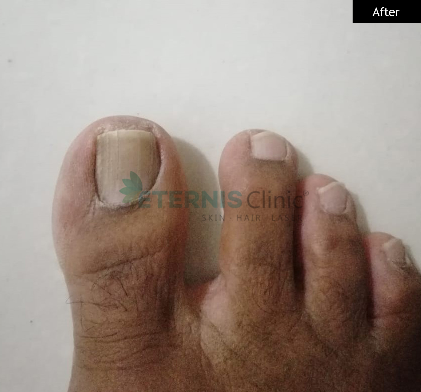 After: Ingrown nail correction