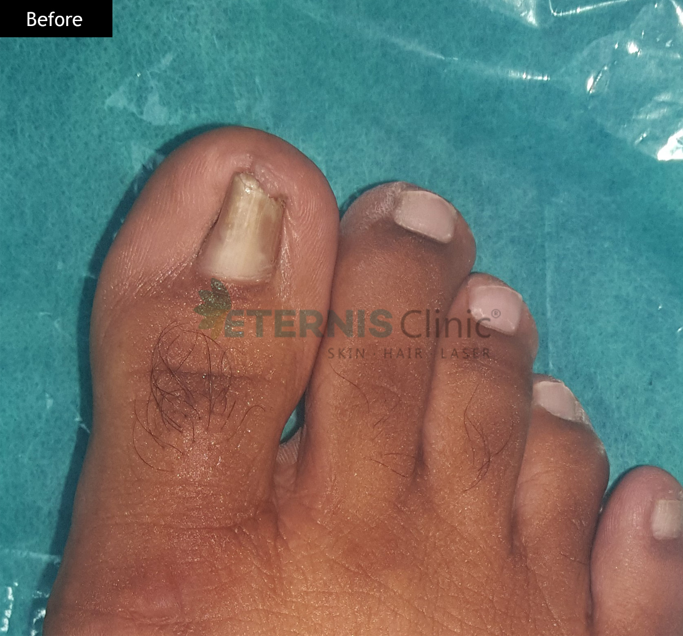 Before: Ingrown nail correction