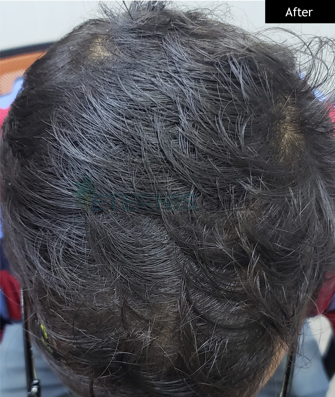 After: Diffuse hair fall, 6 GFC sessions