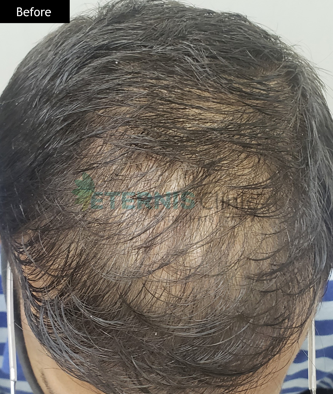 Before: Diffuse hair fall, 6 GFC sessions