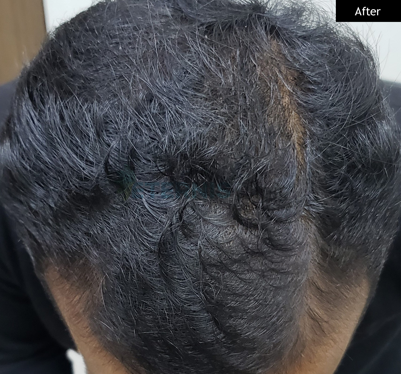 After: Hair loss with thinning, 8 sessions