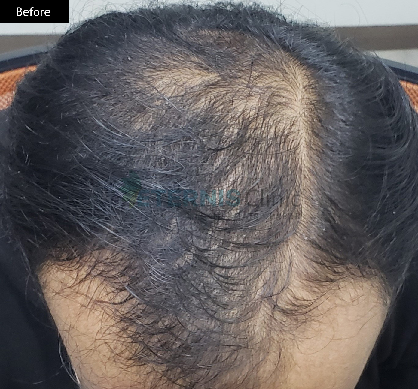 Before: Hair loss with thinning, 8 sessions