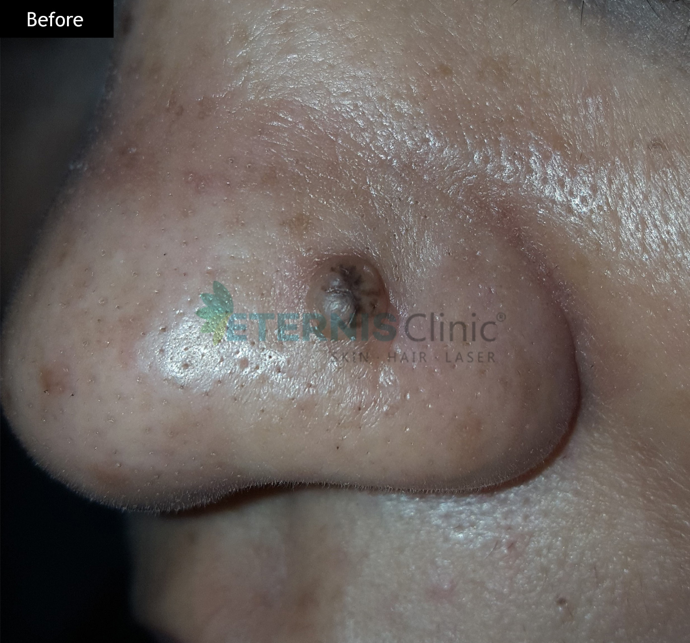 Before: Facial mole, single-session removal