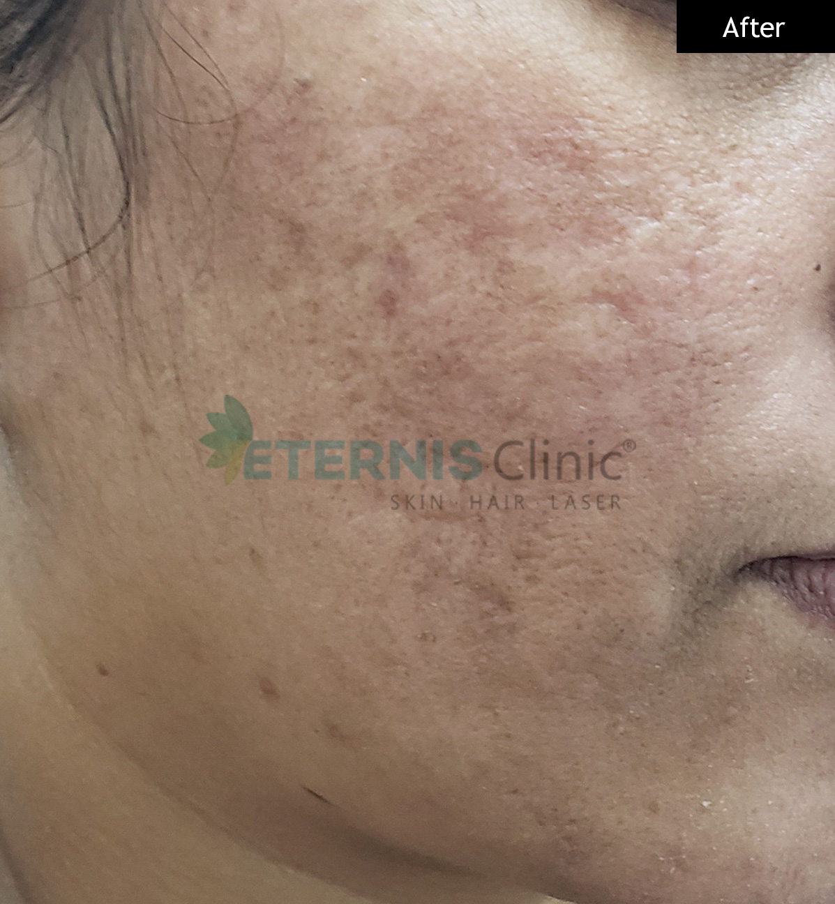 After: Severe acne, 12 weeks of doctor-led treatment