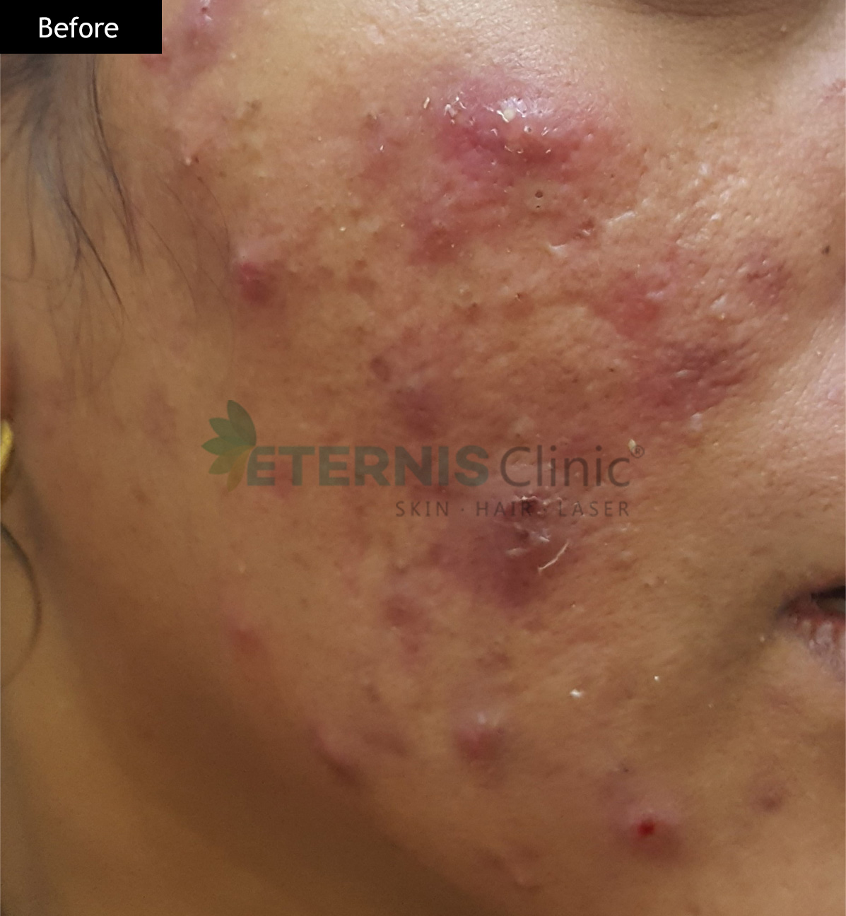 Before: Severe acne, 12 weeks of doctor-led treatment