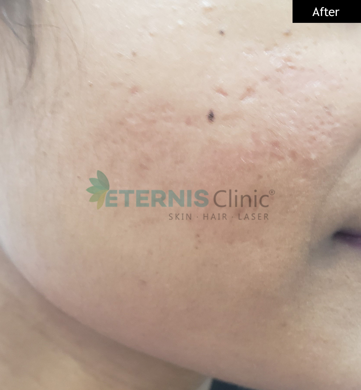 After: Hormonal acne, 14 weeks