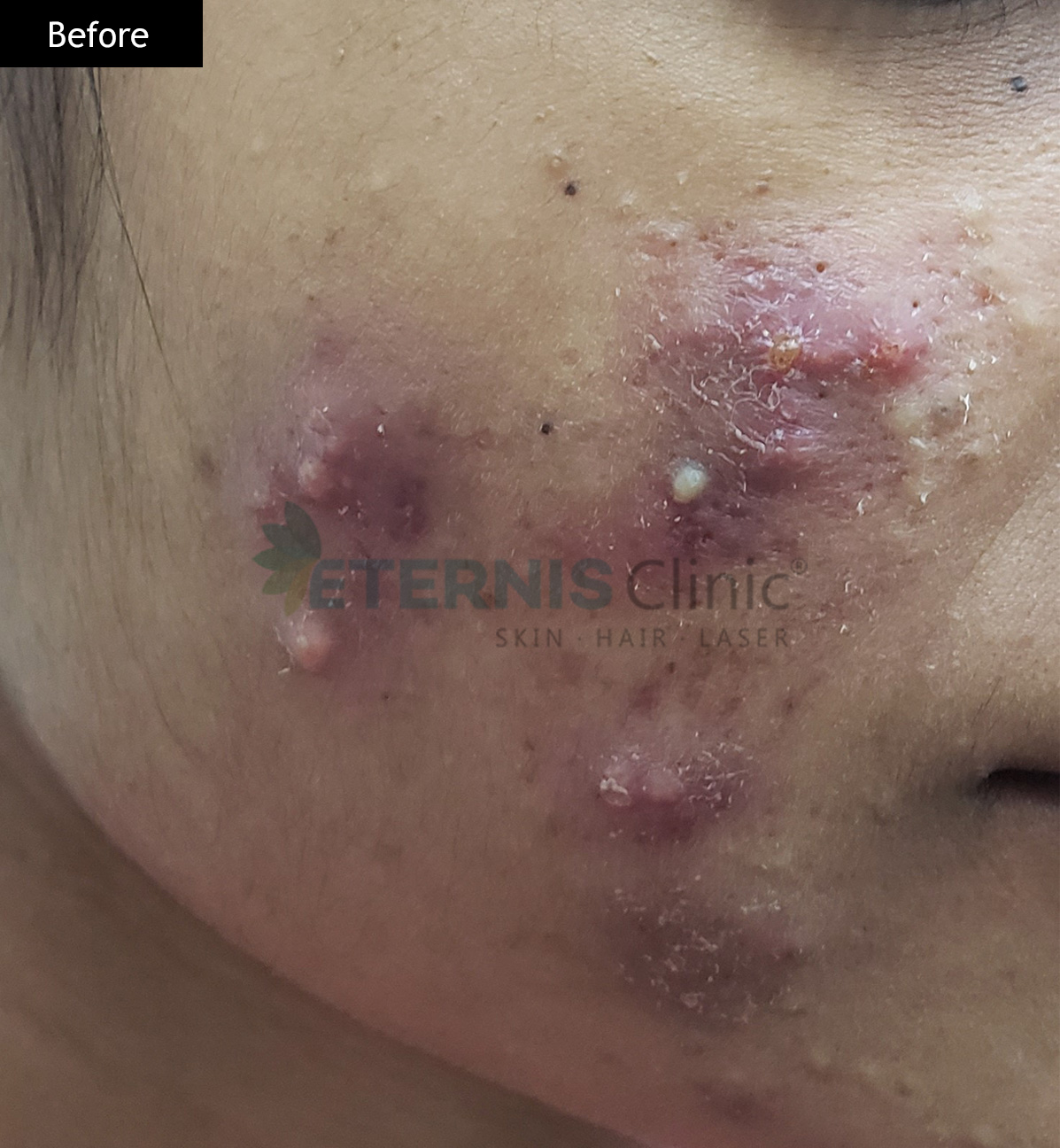 Before: Hormonal acne, 14 weeks
