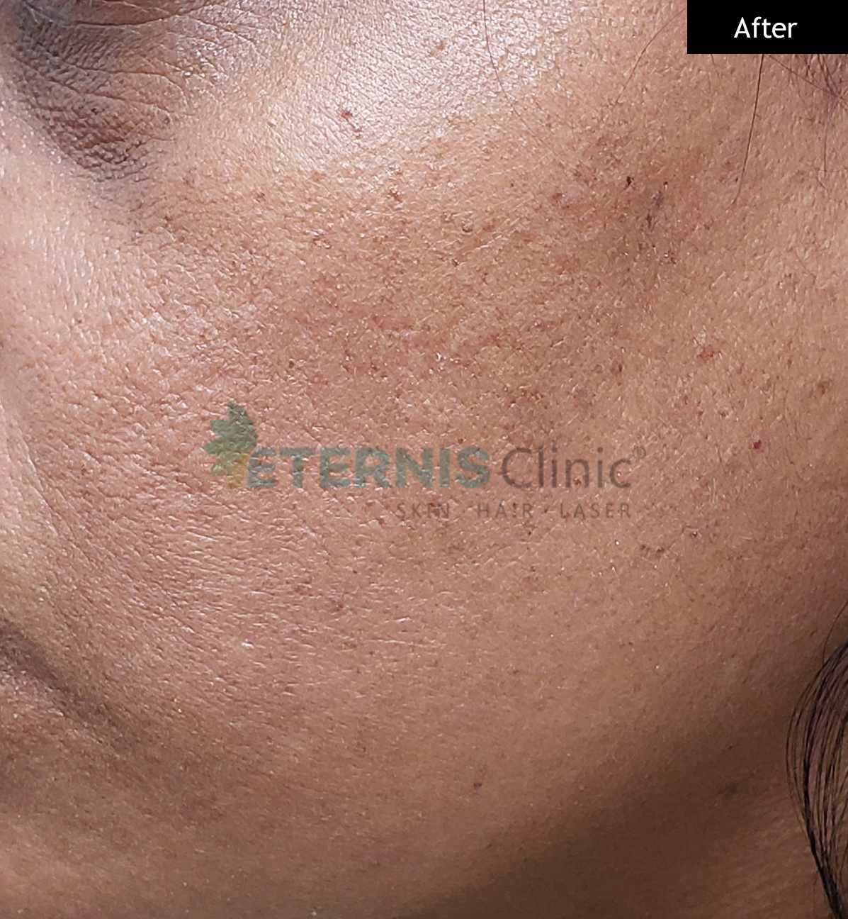 After: Skin tag, single-session removal
