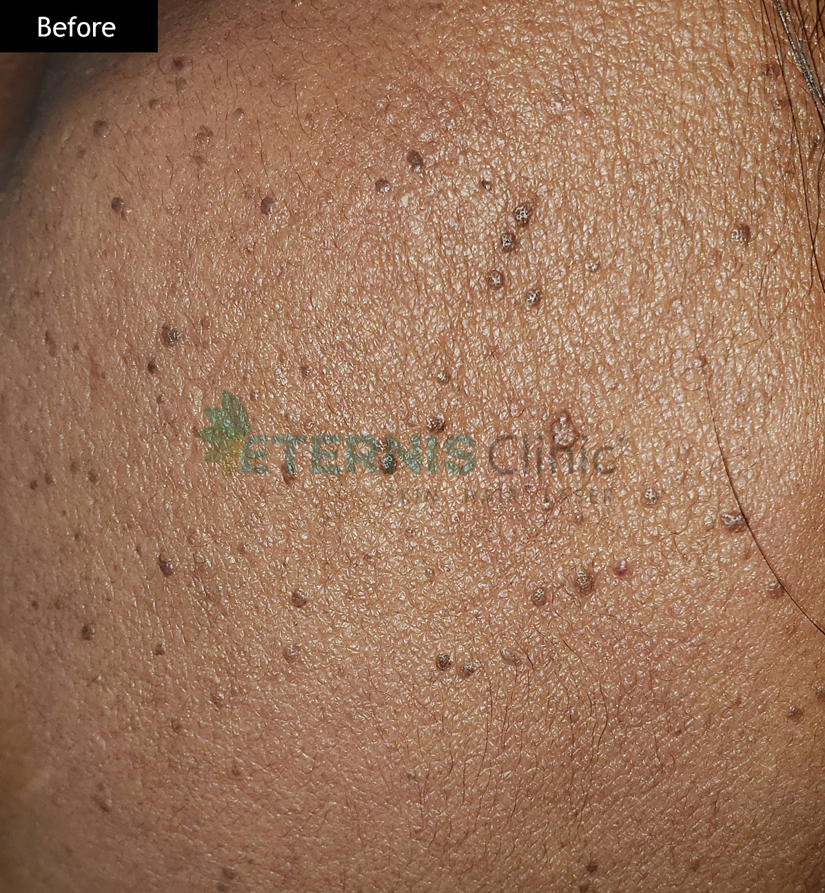 Before: Skin tag, single-session removal