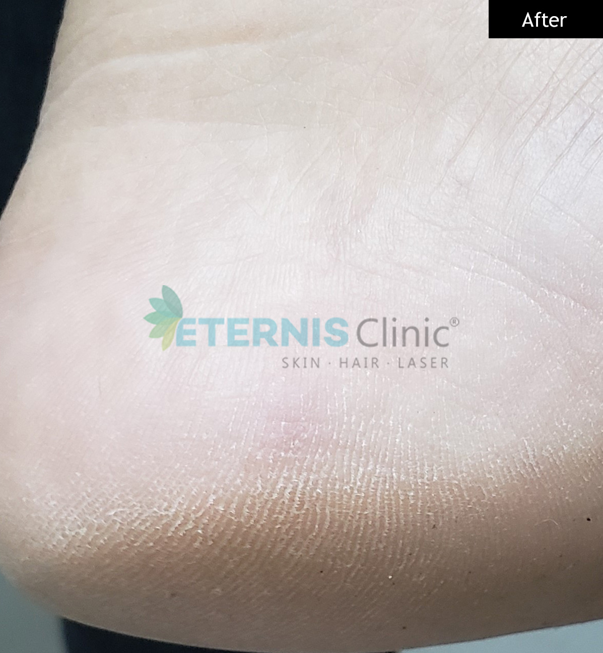 After: Wart on foot, single session