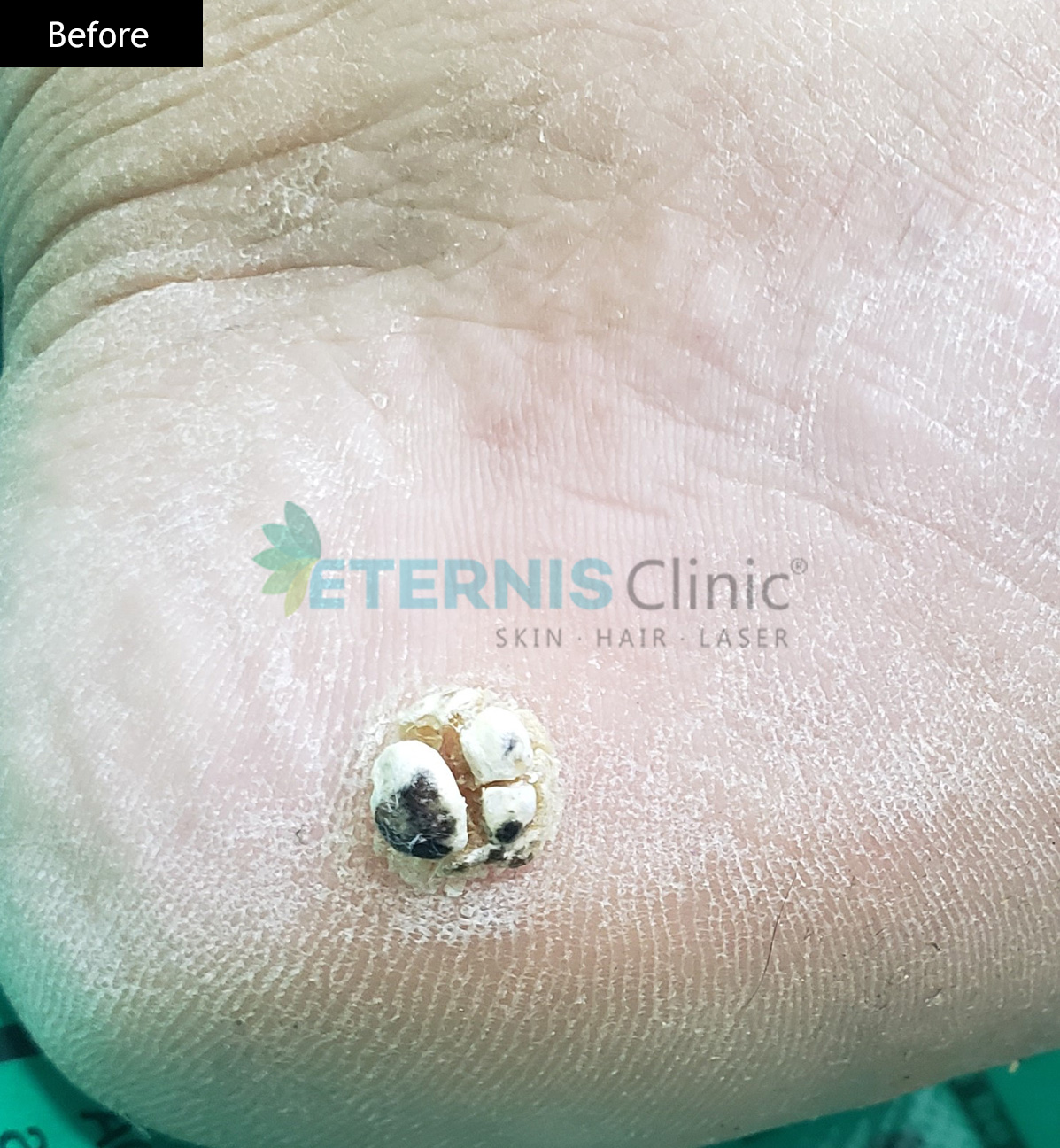 Before: Wart on foot, single session