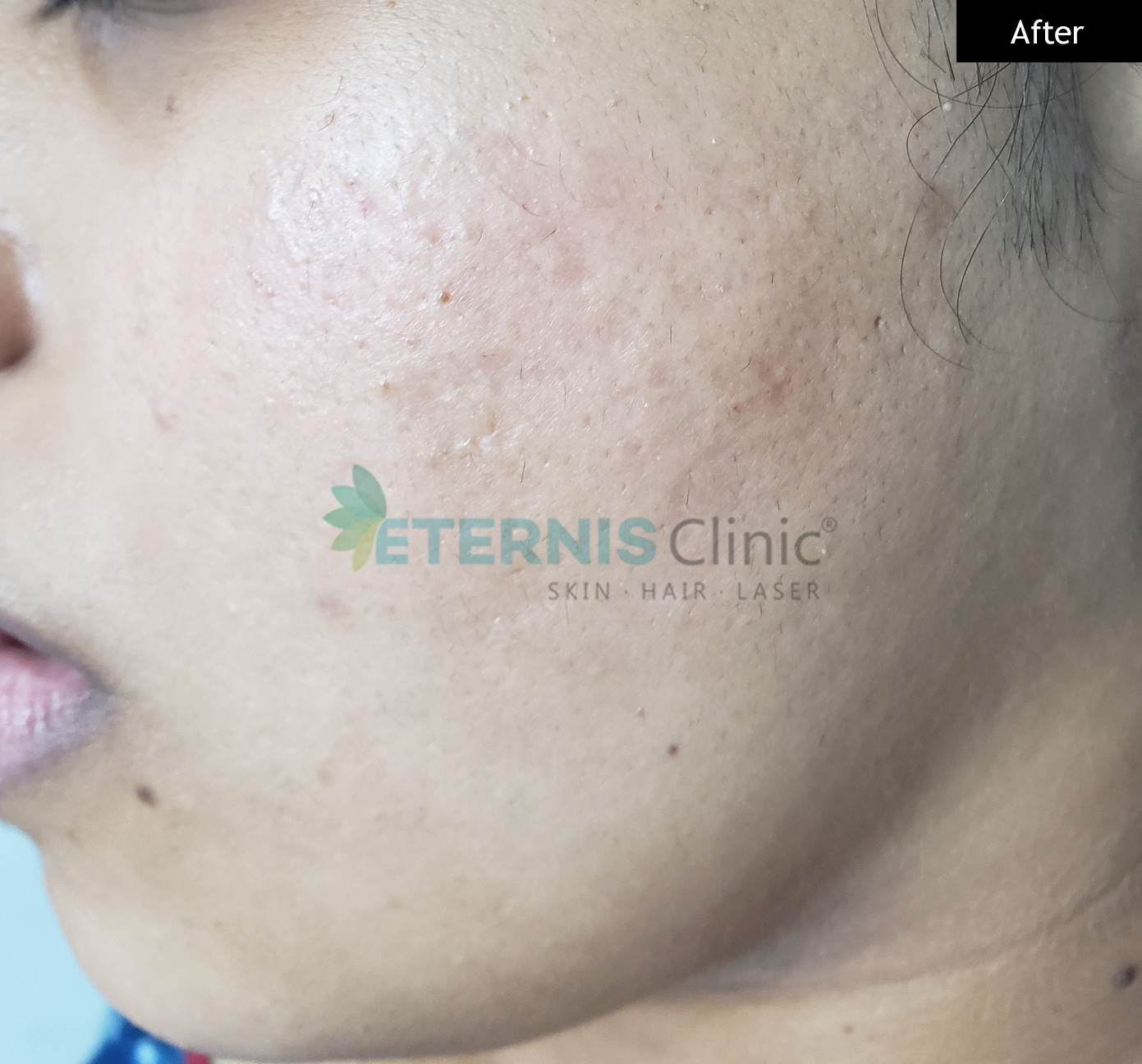 After: Acne with textural scarring, 4 sessions