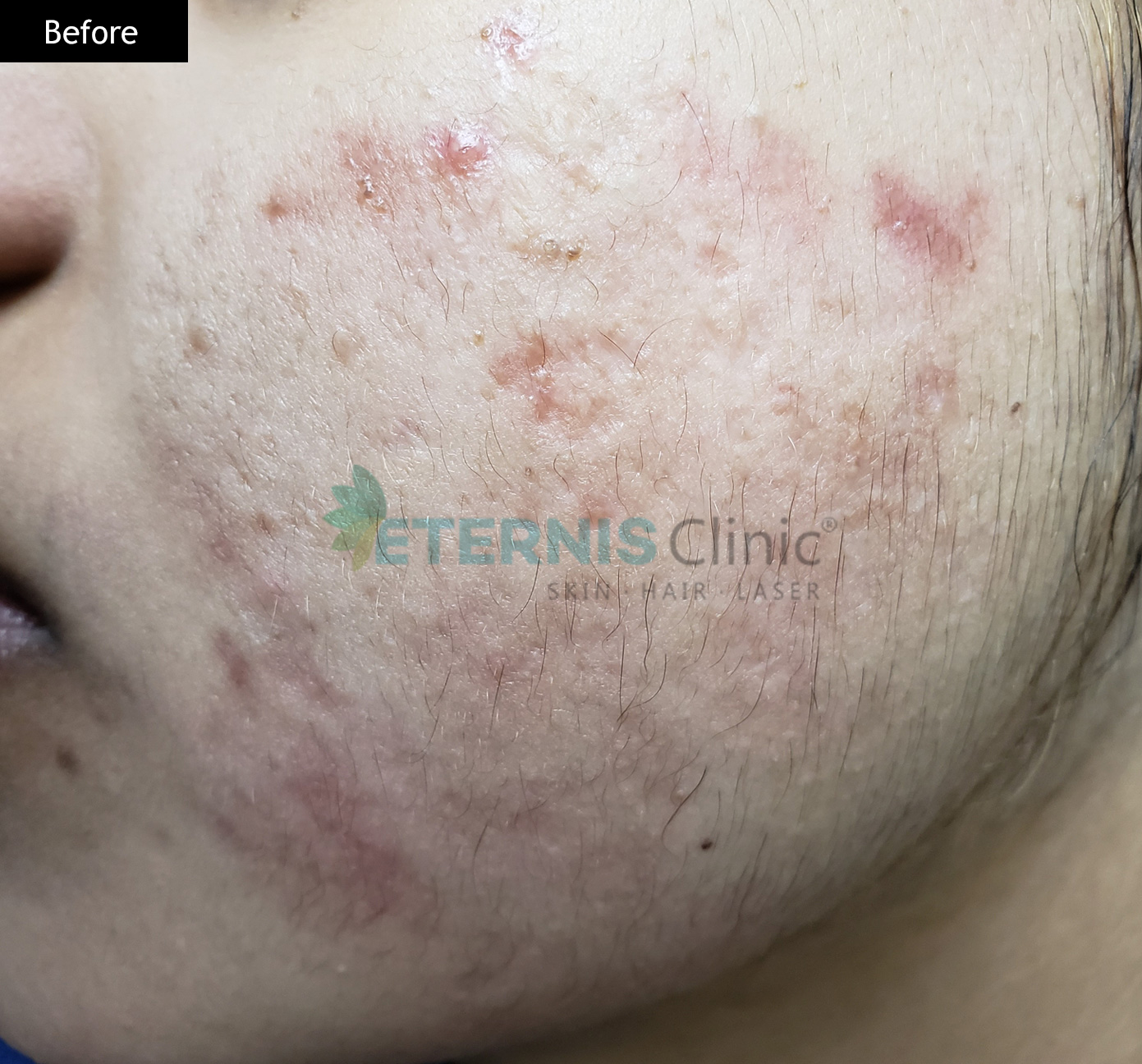 Before: Acne with textural scarring, 4 sessions