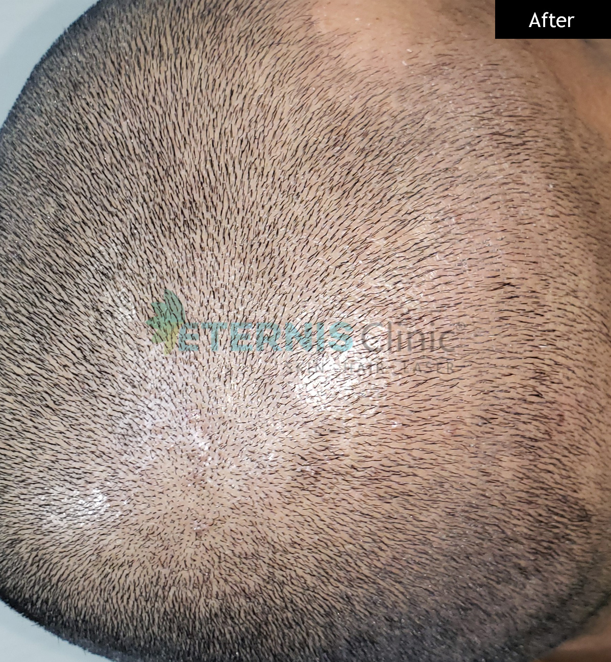 After: Scalp warts, single session