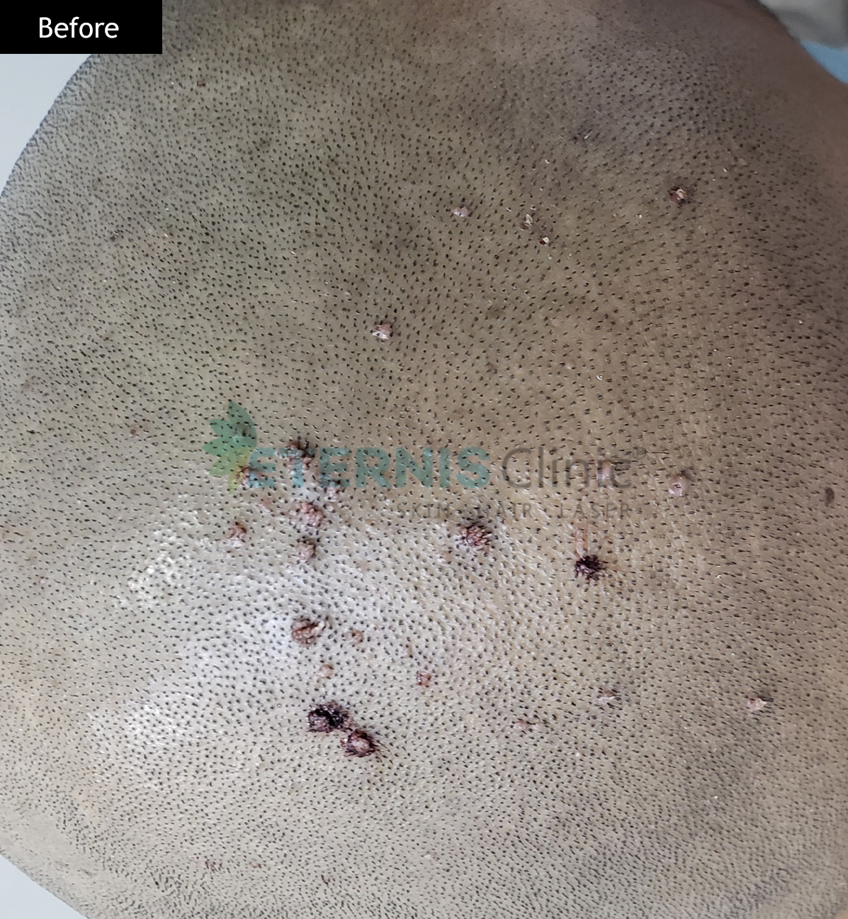 Before: Scalp warts, single session