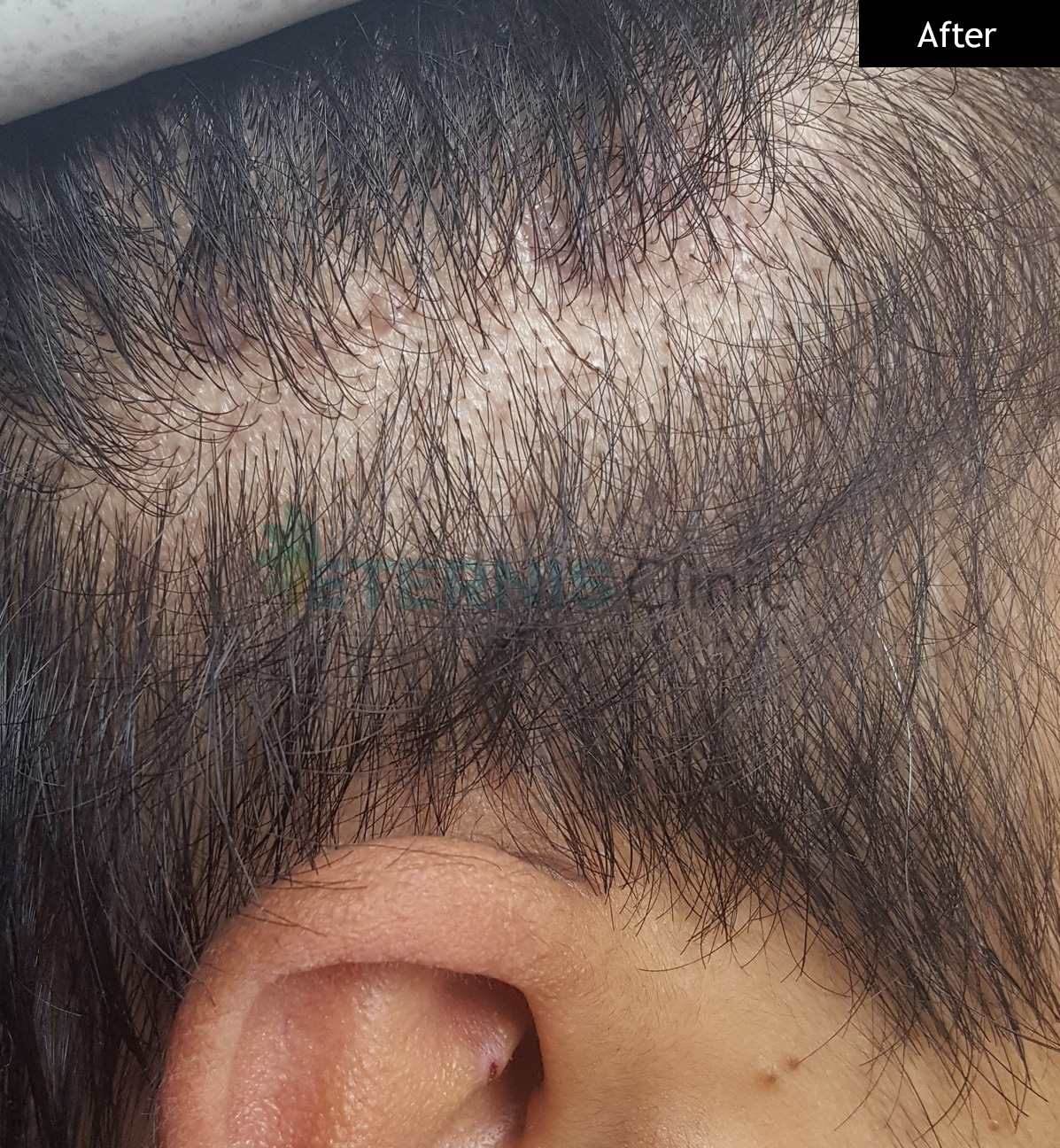 After: Warts cluster removal