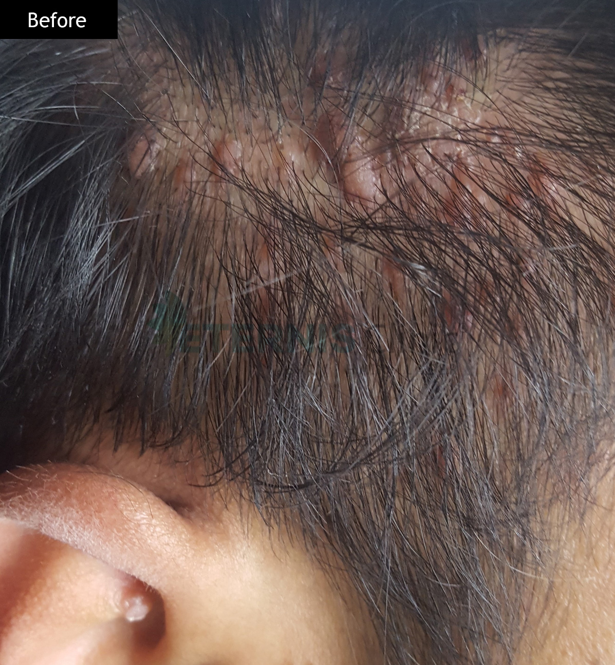 Before: Warts cluster removal