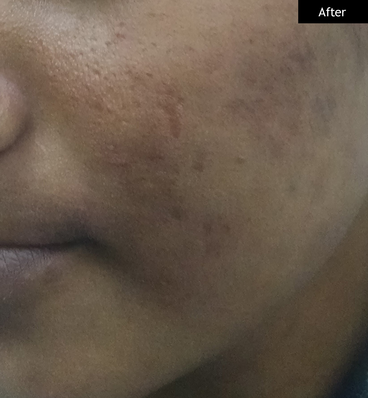 After: Cystic acne, 16 weeks
