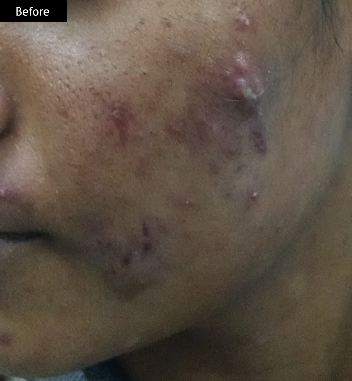 Before: Cystic acne, 16 weeks