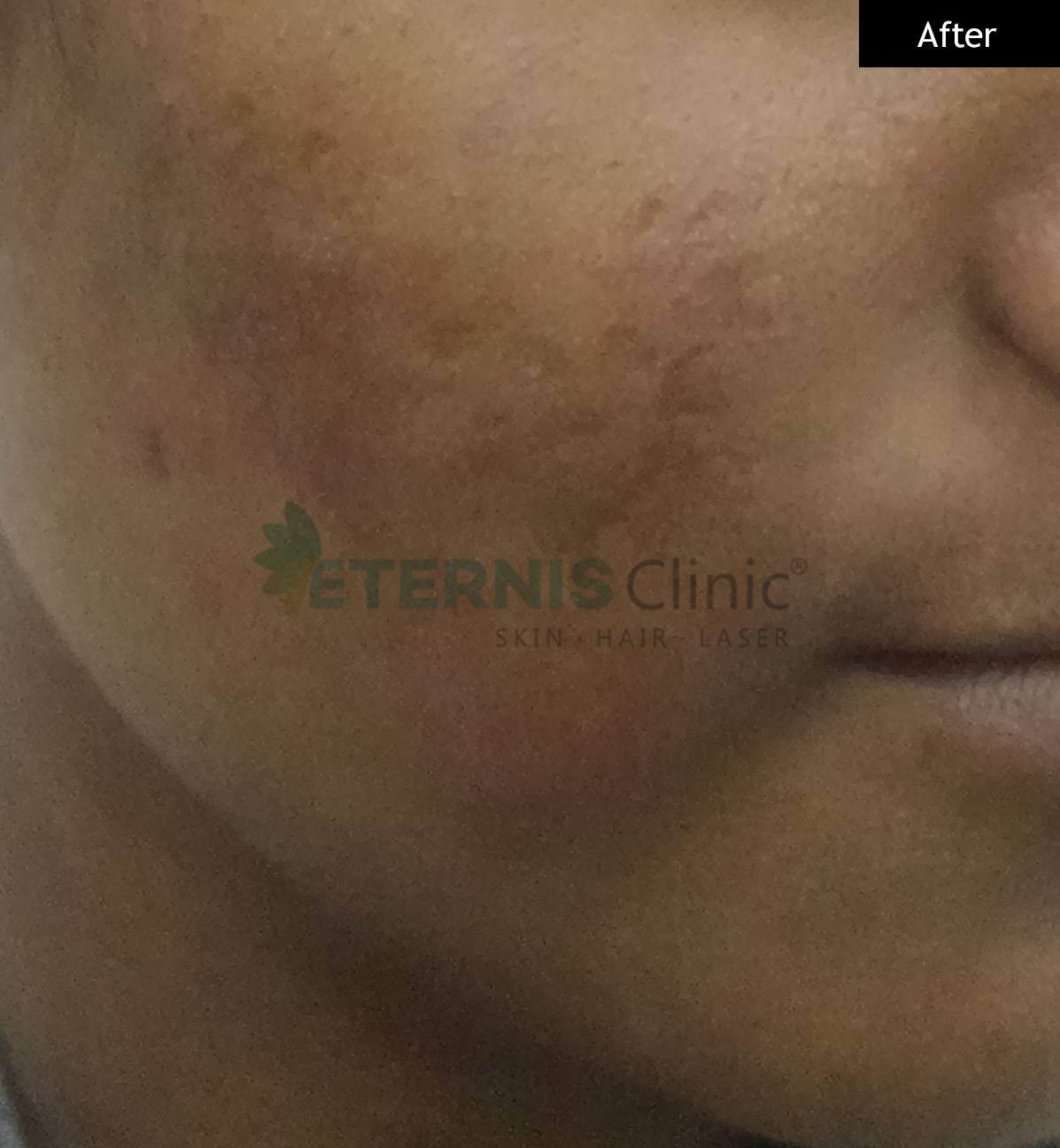 After: Cystic acne with scarring, 18 weeks