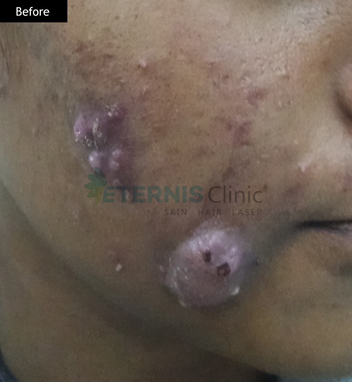 Before: Cystic acne with scarring, 18 weeks
