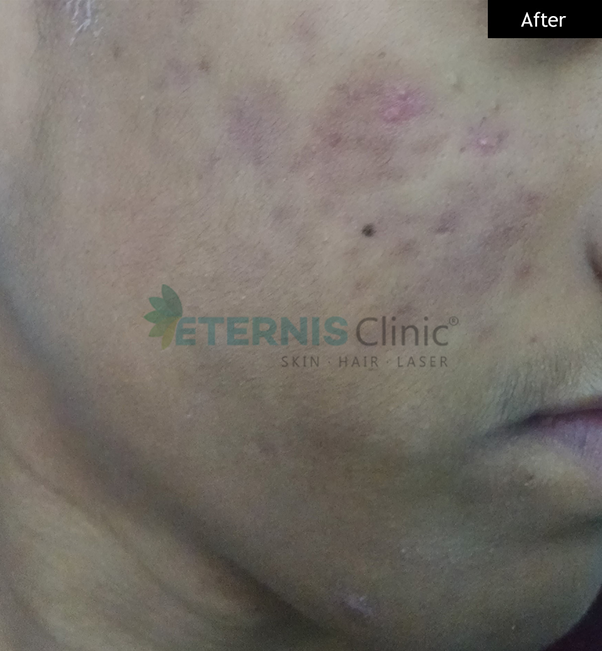 After: Severe inflammatory acne, 12 weeks
