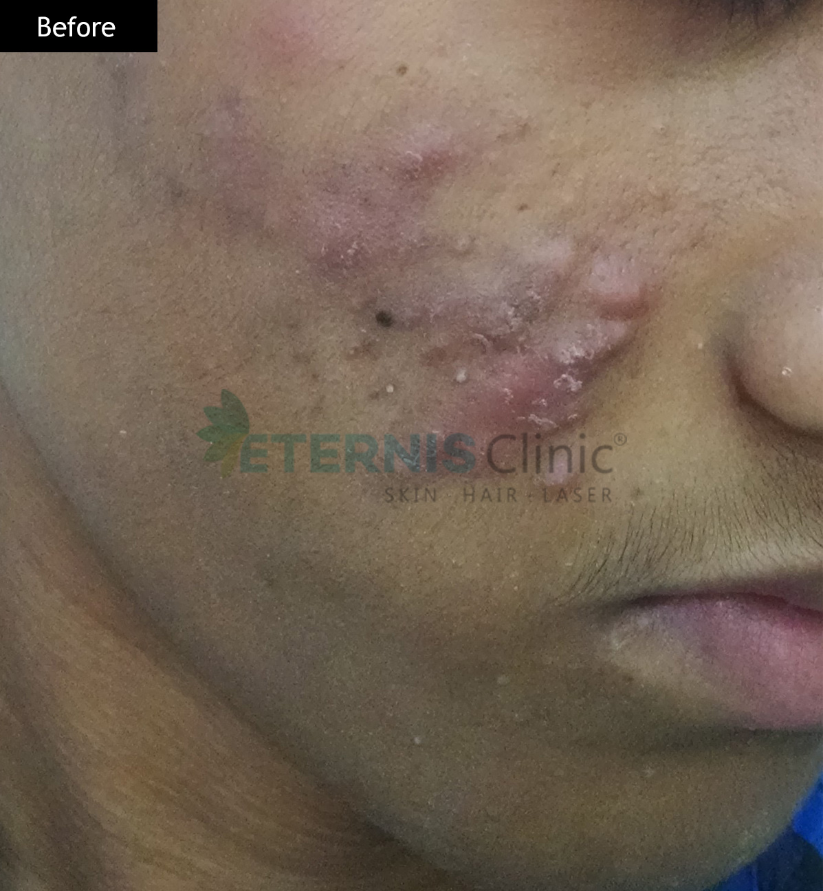 Before: Severe inflammatory acne, 12 weeks