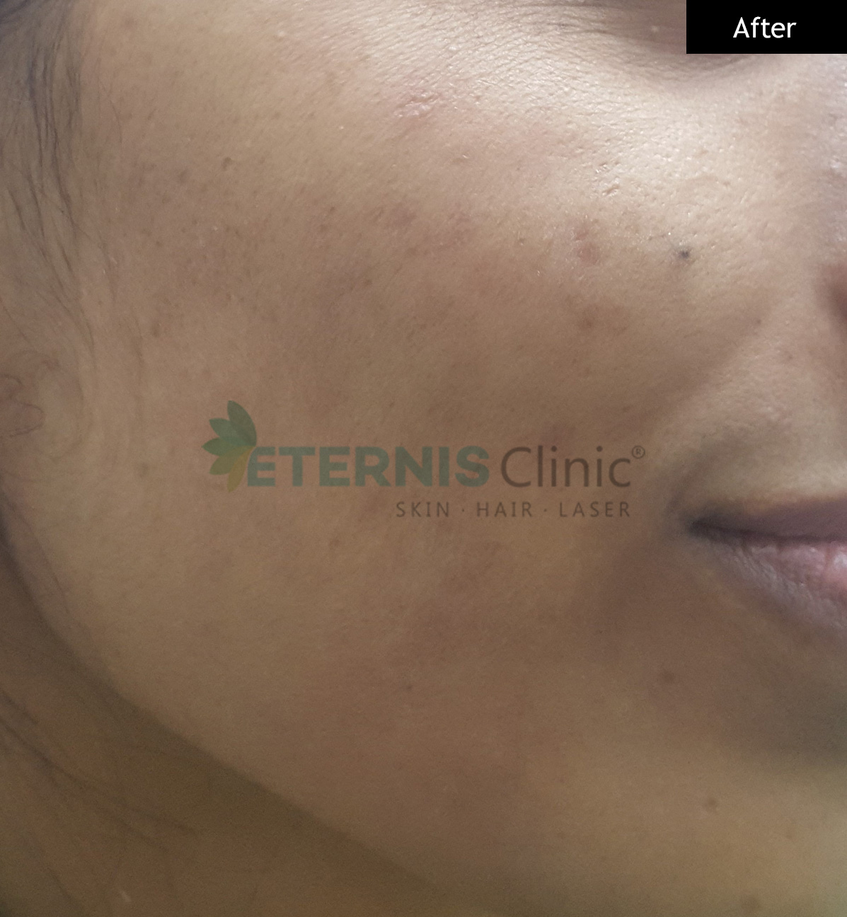 After: Post-acne marks plus texture, 6 sessions