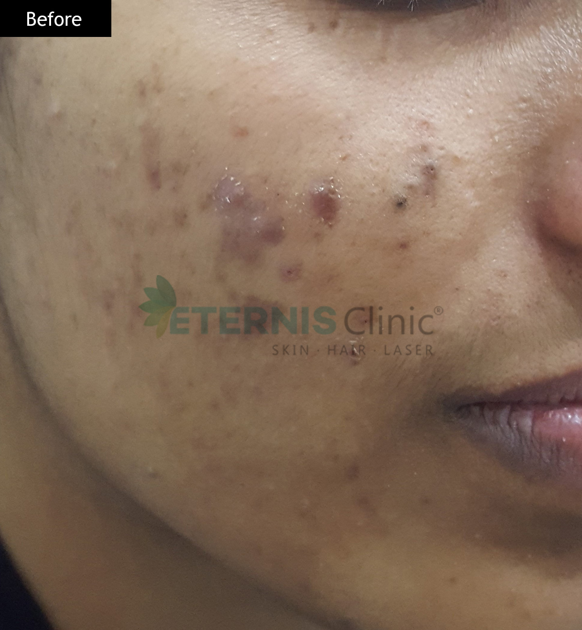 Before: Post-acne marks plus texture, 6 sessions