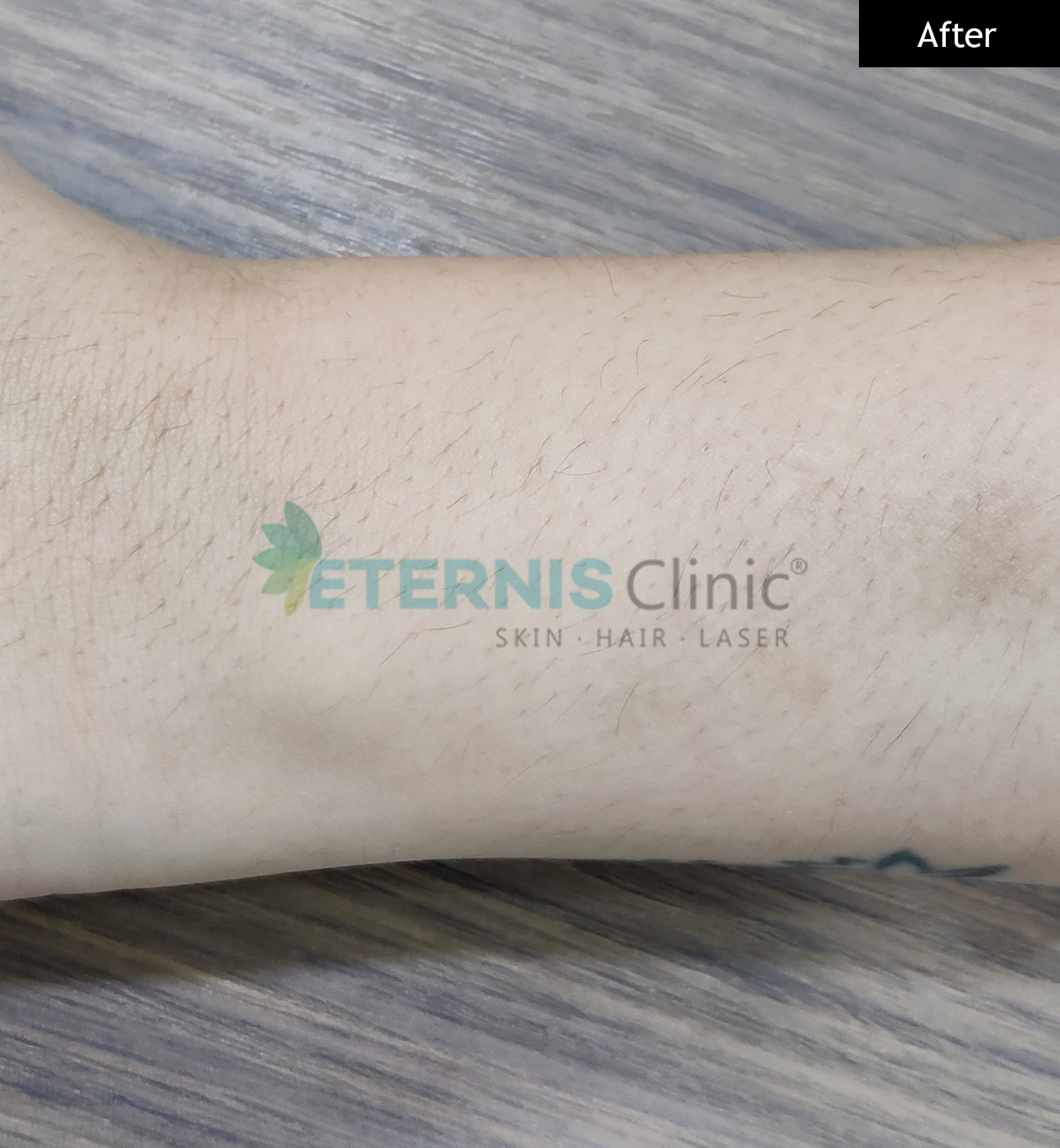 After: Burn scar revision