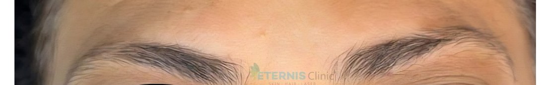 Before: Nano-brow restoration, natural arch definition