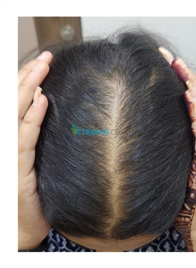 After: Female pattern hair thinning, doctor-led plan