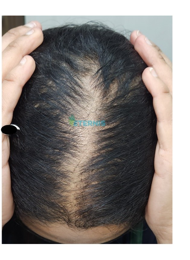 Before: Female pattern hair thinning, doctor-led plan