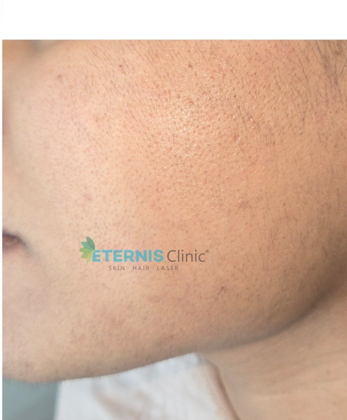 After: Facial hair reduction with diode laser