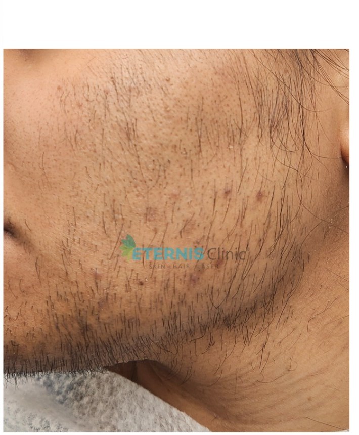 Before: Facial hair reduction with diode laser