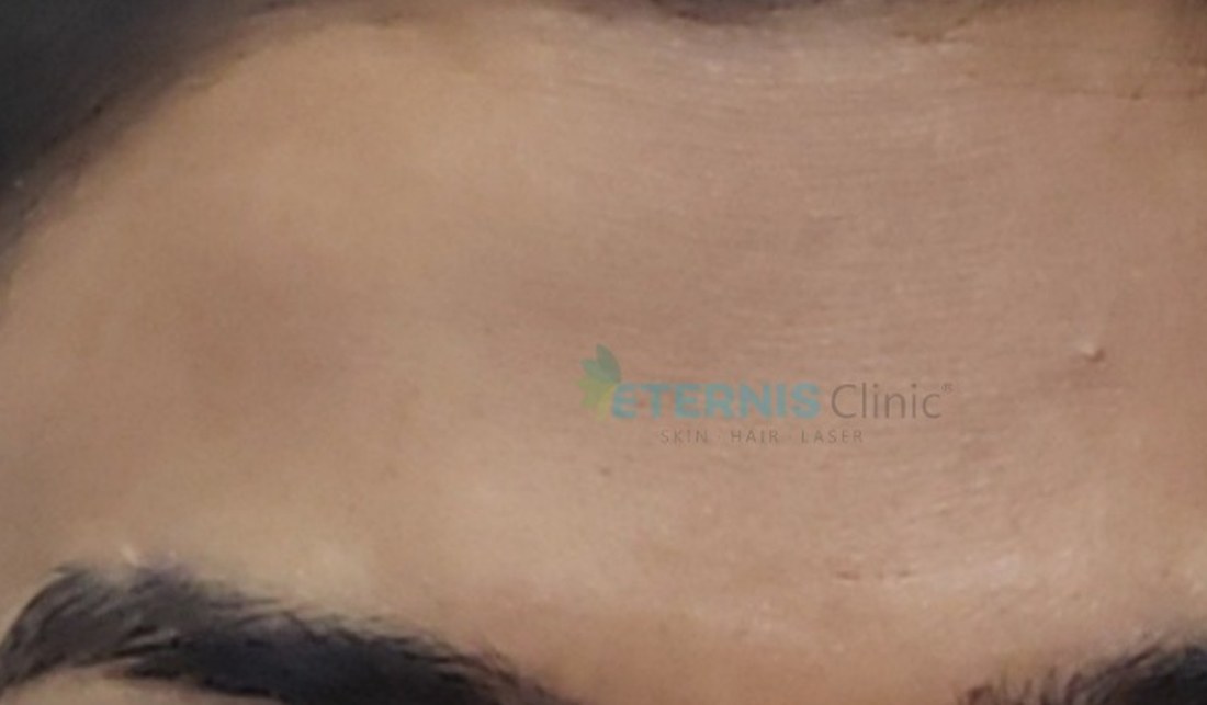 After: Forehead lines softened with anti-wrinkle therapy