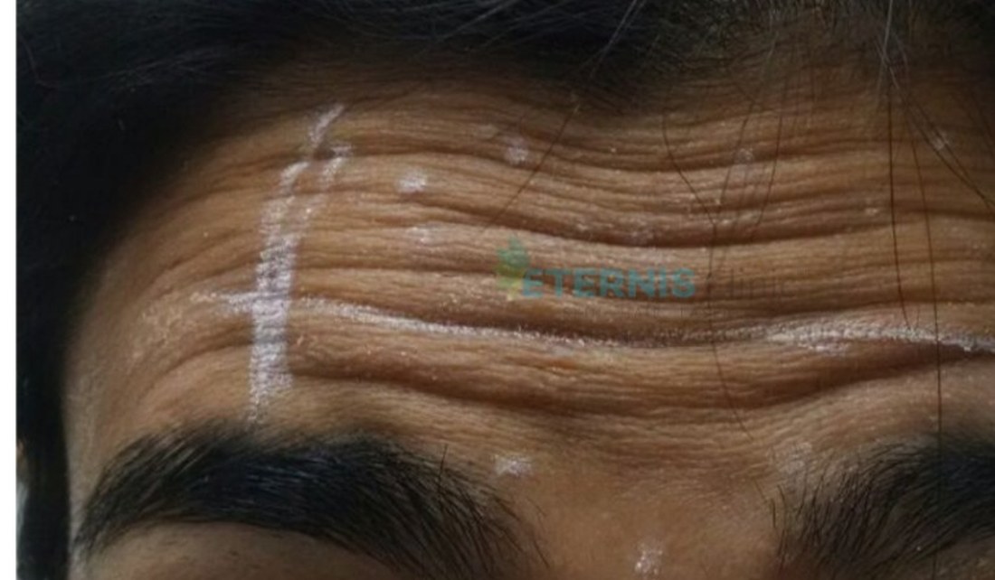Before: Forehead lines softened with anti-wrinkle therapy