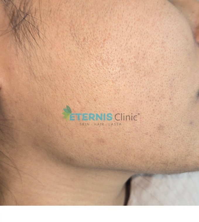 After: Hirsutism, facial laser hair removal
