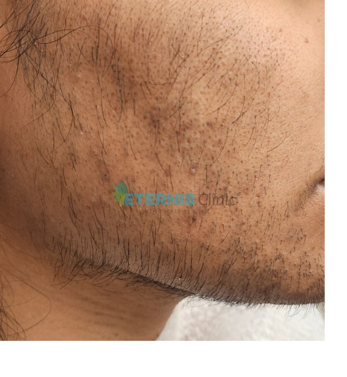 Before: Hirsutism, facial laser hair removal