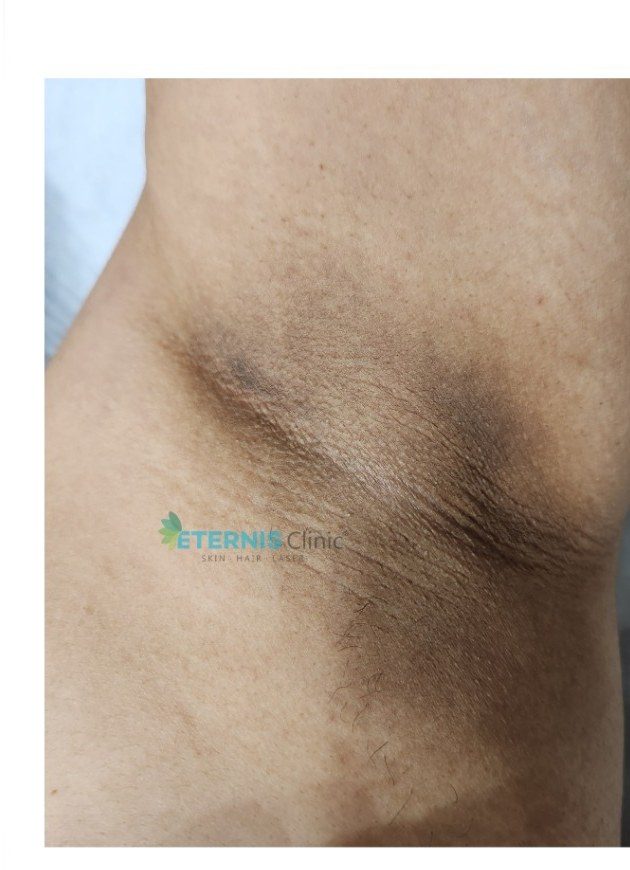 After: Underarm laser hair removal