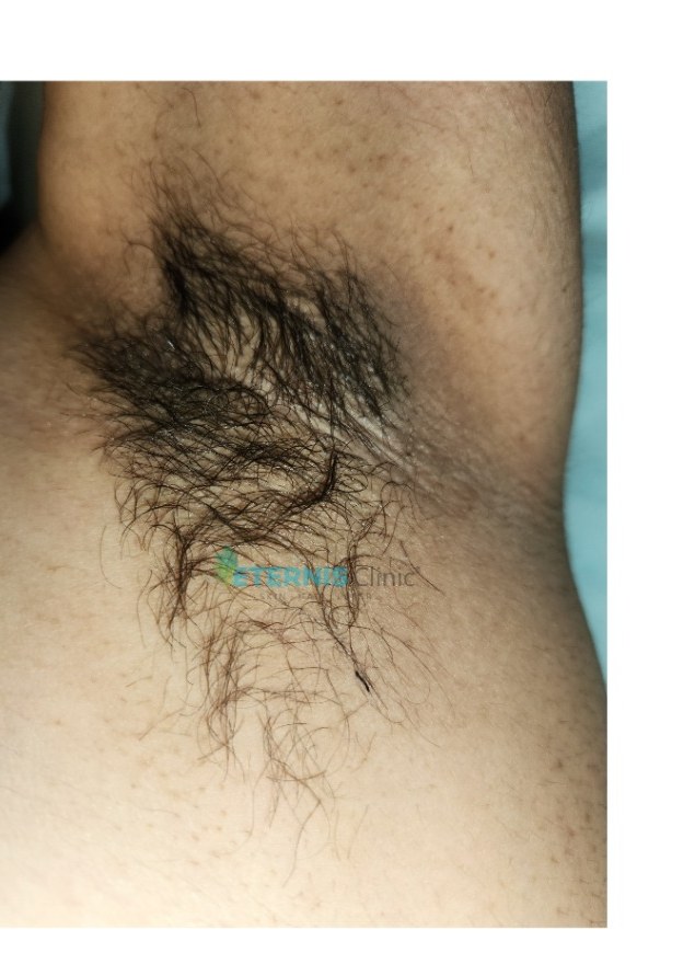 Before: Underarm laser hair removal