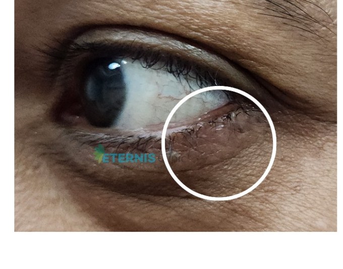 After: Eyelid mole removal, single session