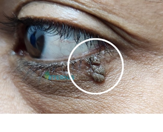 Before: Eyelid mole removal, single session