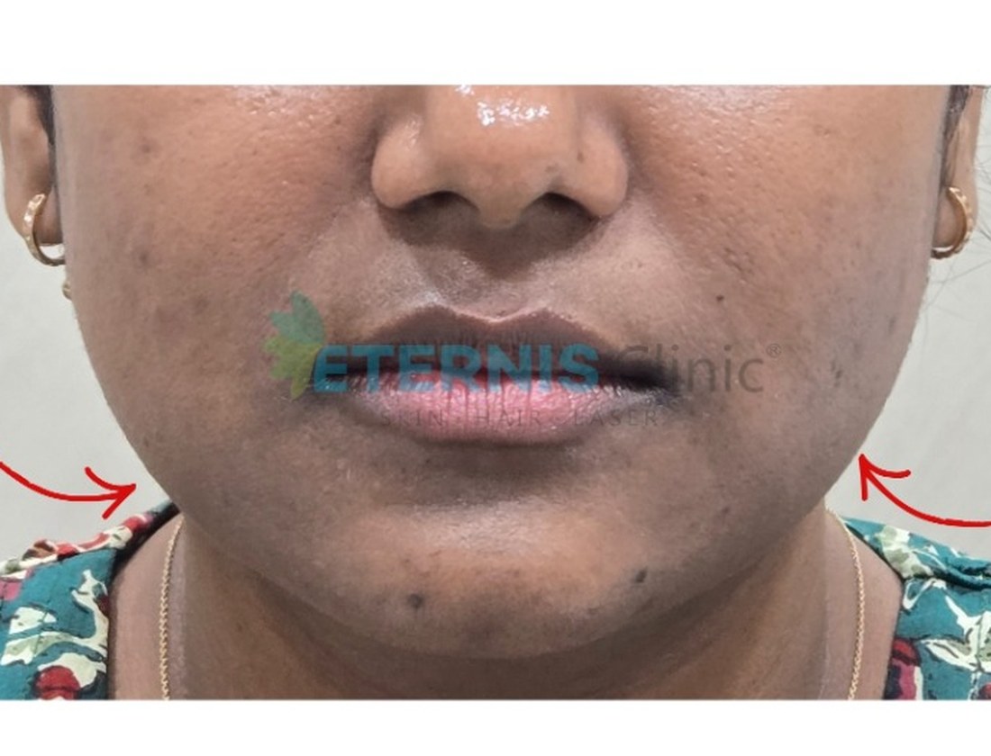 After: Jawline contouring with masseter therapy