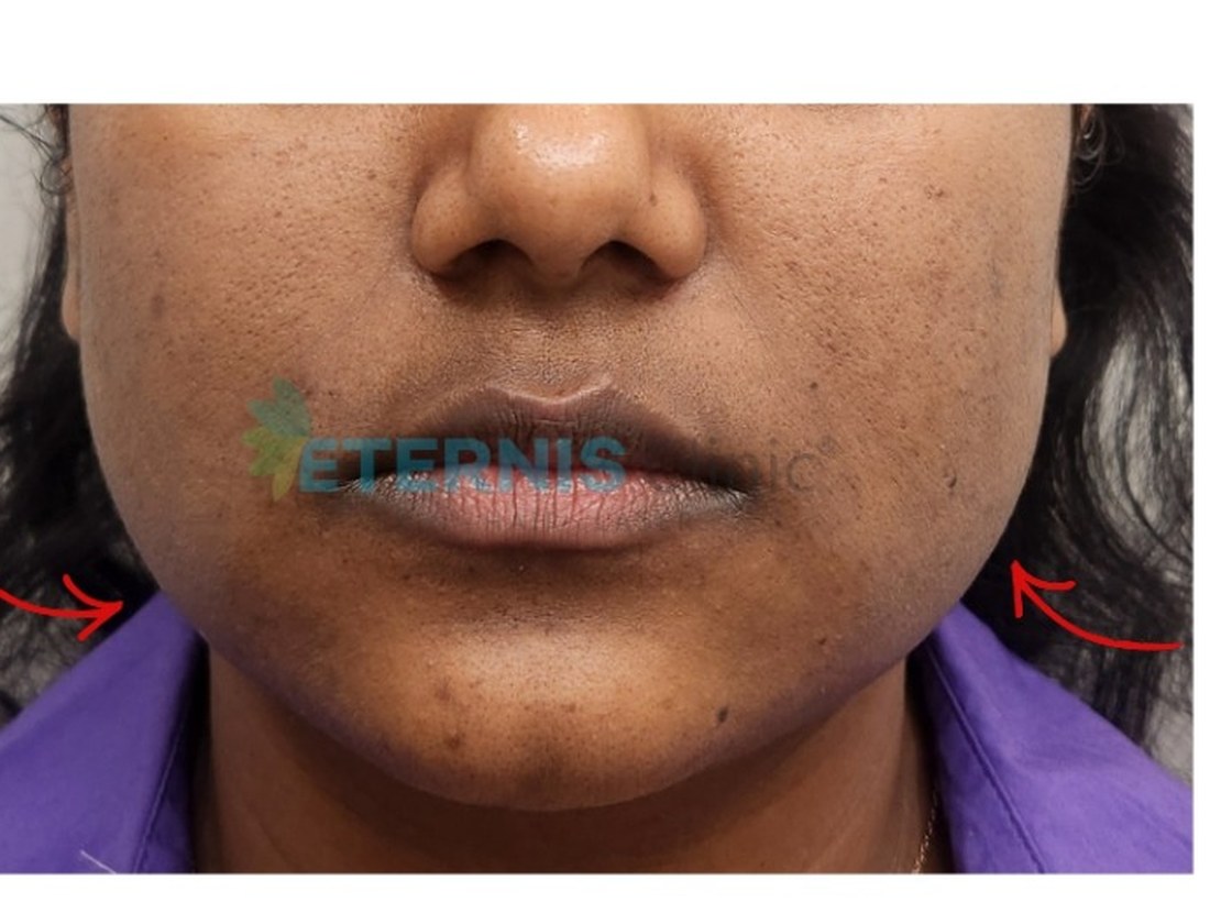 Before: Jawline contouring with masseter therapy