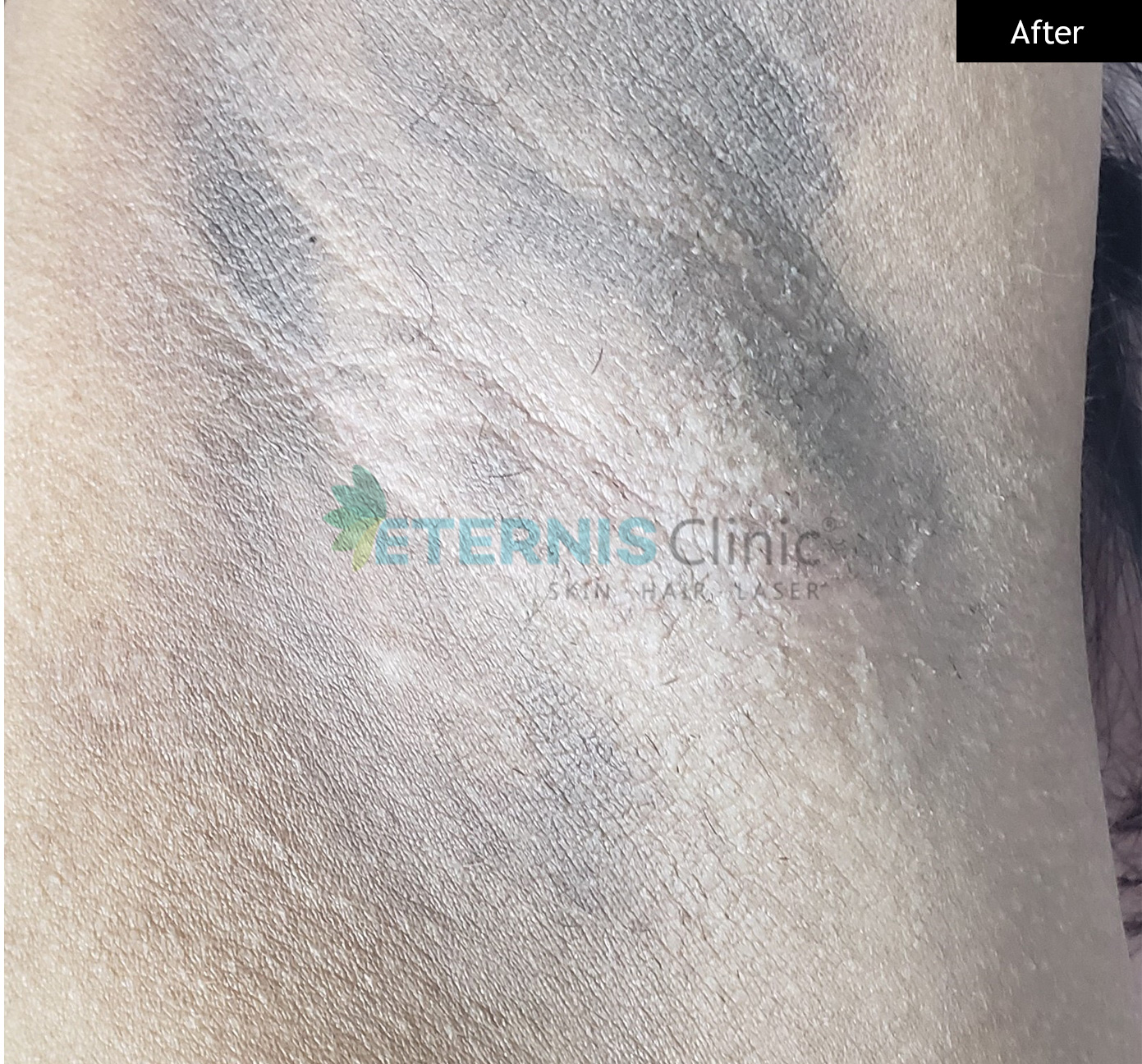 After: Underarm pigmentation, 4 sessions